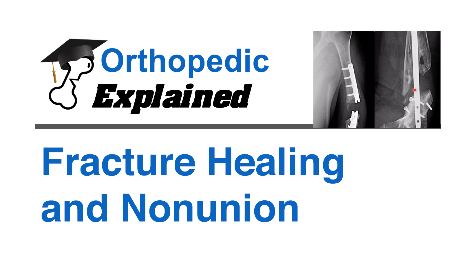 Fracture Healing and Nonunion