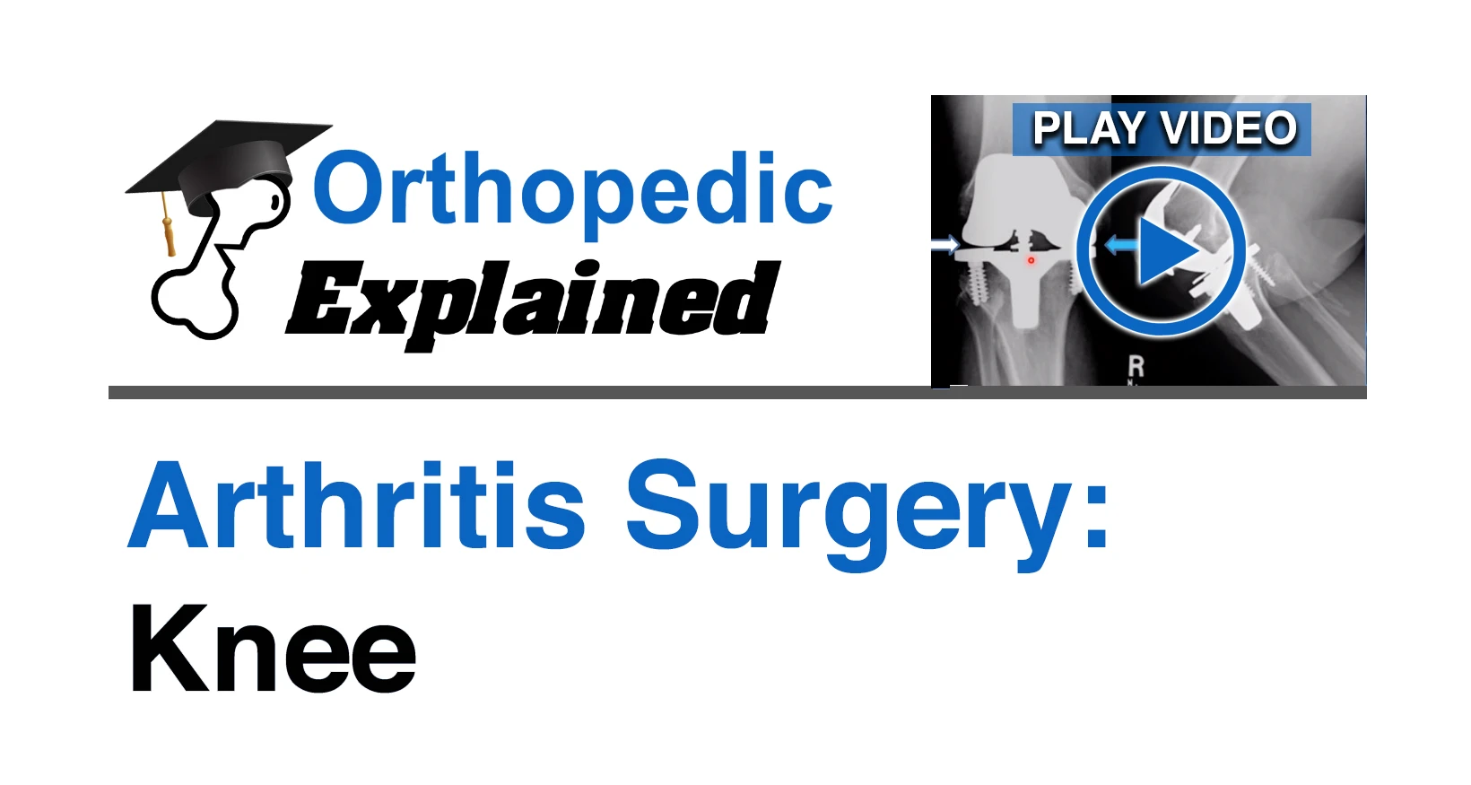 Arthritis Surgery: Knee