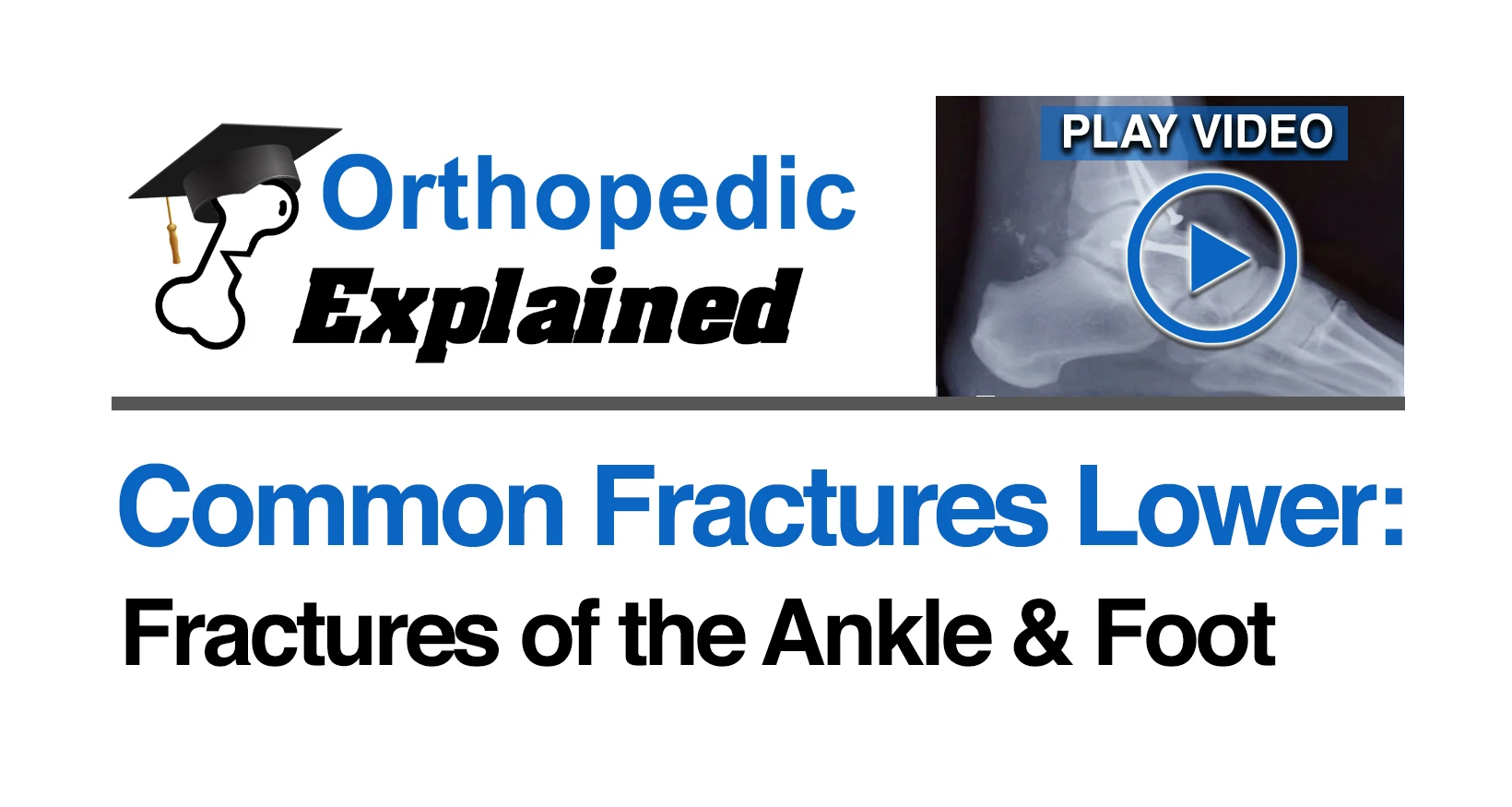 Fractures of the ankle and foot