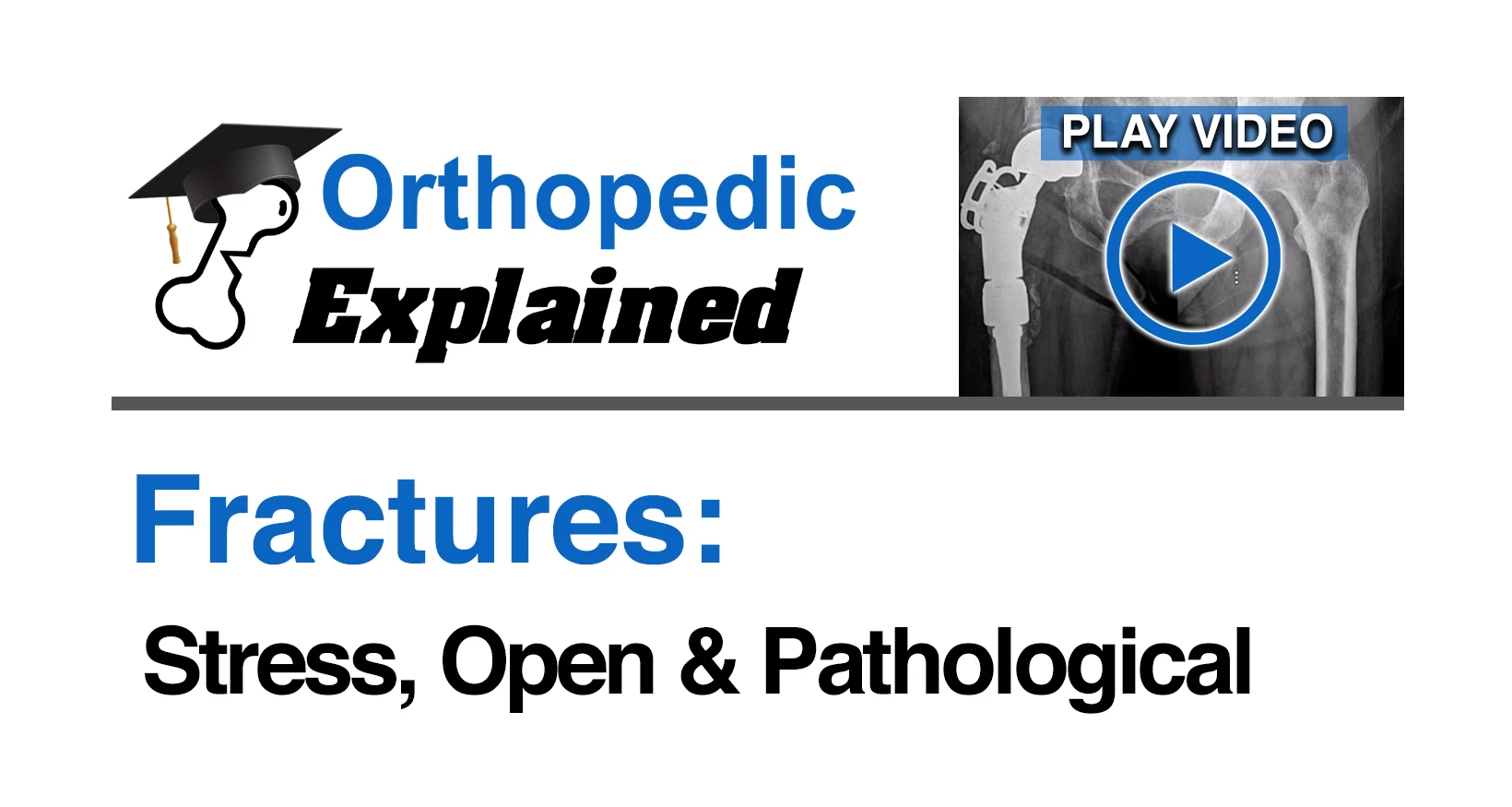Fractures of the ankle and foot