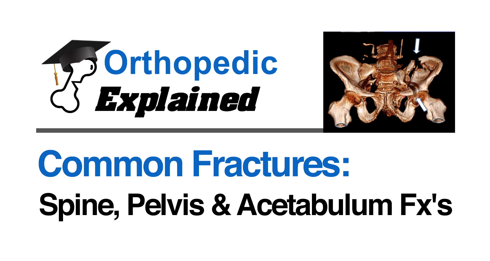 Fracture-Spine, Pelvis & Acetabulum Fx’s