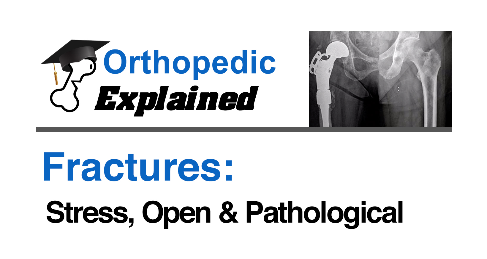 Fractures-Stress, Open & Pathological