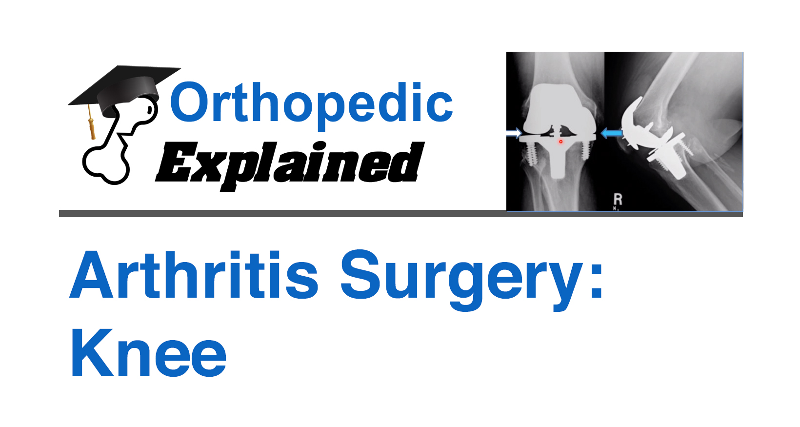 Arthritis Surgery: Knee