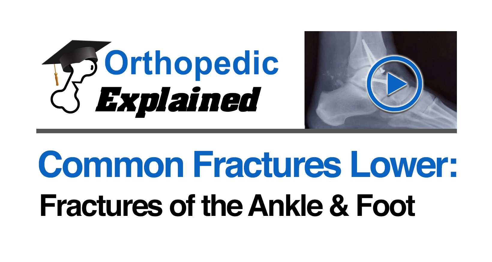 Fractures of the ankle and foot