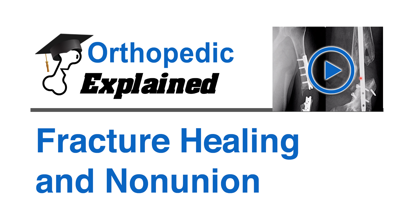 Fracture Healing and Nonunion