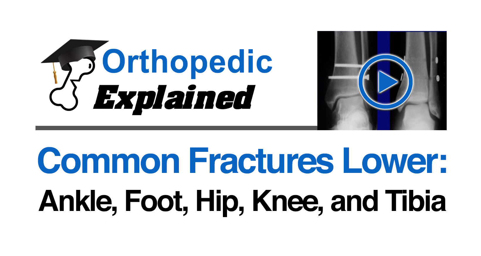 Common Fractures of the Hip, Knee & Tibia